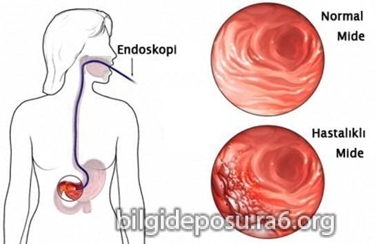 Mide kanseri tedavisi ve mide kanseri ameliyatı sonrası