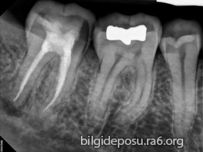 Diş tedavisinde önemli şey: Panaromik Röntgen