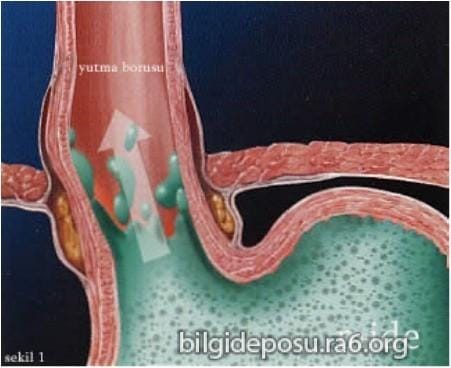 Reflüye ne iyi gelir? Reflü tedavisi nasıldır?